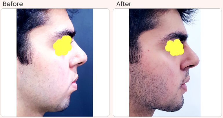 Skin Laser Treatment in Lucknow
