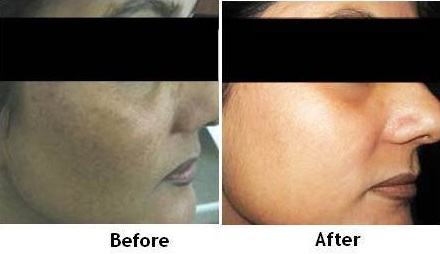 Best Chemical Peel doctor in Lucknow