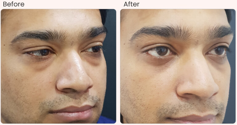 Best Blepharoplasty Surgery Clinic in Lucknow