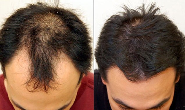 Best hair transplant clinic in Lucknow