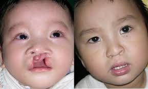 Best LIP surgery clinic in Lucknow