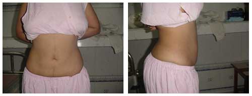 Best Liposuction Doctor in Lucknow