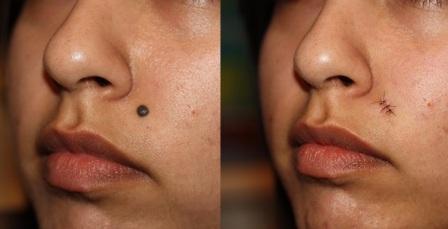 Best Mole Removal treatment clinic in Lucknow