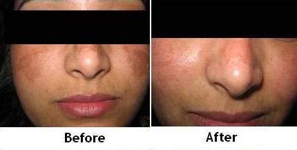 Best Chemical Peel doctor in Lucknow