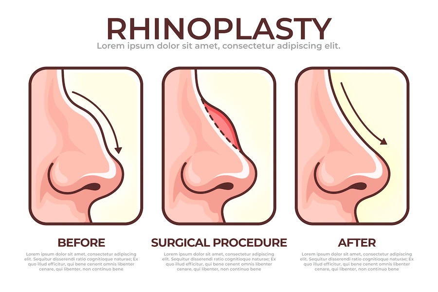 Best Rhinoplasty Surgery Clinic in Lucknow
