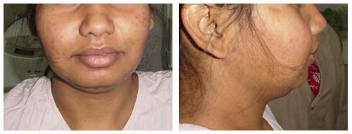 Nose Plastic Surgery In Lucknow