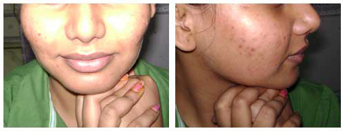 Best Rhinoplasty Surgery Clinic in Lucknow